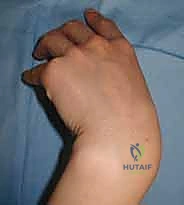 تشريح عظم الزورقي ومناطقه المختلفة