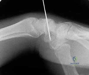 صورة توضيحية لـ تثبيت كسر الزورقي عن طريق الجلد: دليل شامل للمرضى مع الأستاذ الدكتور محمد هطيف