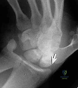 صورة توضيحية لـ تثبيت كسر الزورقي عن طريق الجلد: دليل شامل للمرضى مع الأستاذ الدكتور محمد هطيف