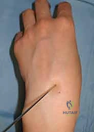 فحص سريري يوضح منطقة الألم في كسر الزورقي