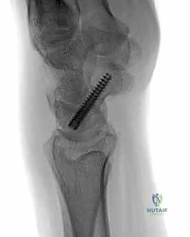 صورة مقارنة توضح العلاج التحفظي مقابل الجراحي