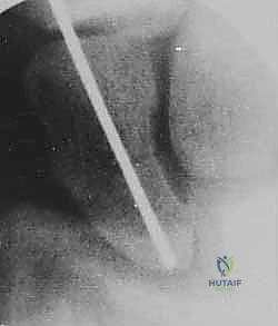 صورة توضيحية لـ تثبيت كسر الزورقي عن طريق الجلد: دليل شامل للمرضى مع الأستاذ الدكتور محمد هطيف