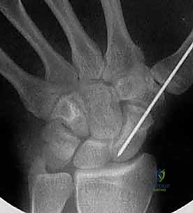 صورة توضيحية لـ تثبيت كسر الزورقي عن طريق الجلد: دليل شامل للمرضى مع الأستاذ الدكتور محمد هطيف