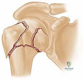 Percutaneous Pinning for Proximal Humerus Fractures: An Intraoperative Masterclass