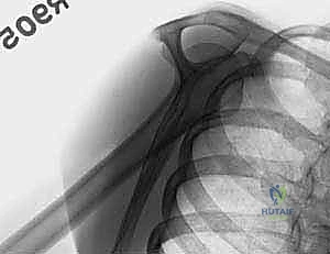 التصوير المقطعي المحوسب للكتف