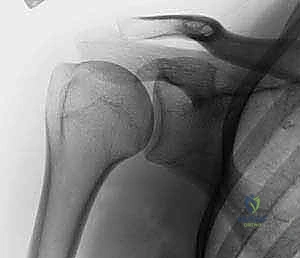 تقييم مدى تضرر الأنسجة الرخوة