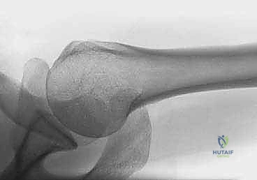 رد الكسر المغلق