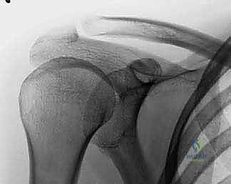 أشعة سينية تظهر كسر مركب