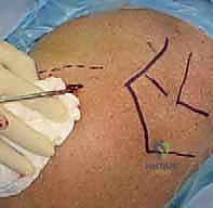 متابعة الأشعة أثناء التثبيت