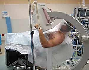 صورة توضيحية لـ تثبيت كسور عظم العضد القريب بالأسلاك عبر الجلد