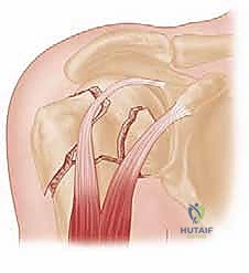 إدخال السلك الأول عبر الجلد