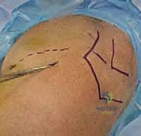 فحص سريري للكتف المصاب