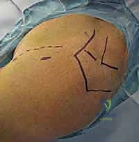 تثبيت كسور عظم العضد القريب بالأسلاك عبر الجلد: دليل شامل للمرضى