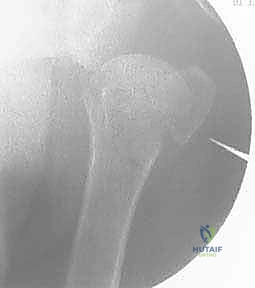 الأوعية الدموية المغذية لمفصل الكتف