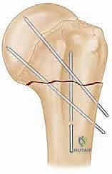 تخطيط ما قبل الجراحة