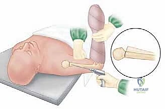 توضيح لتقنية الأسلاك عبر الجلد