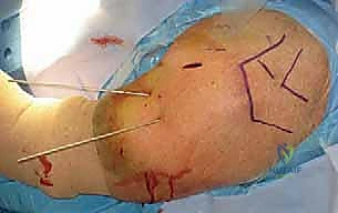 تشريح عظم العضد القريب