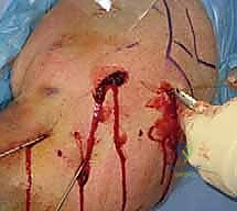 استخدام جهاز الأشعة المرئية C-arm