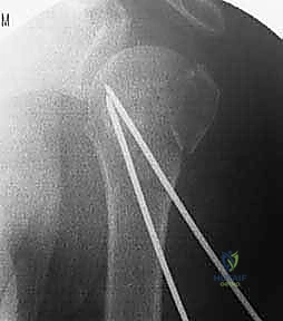 توجيه الأسلاك بدقة متناهية