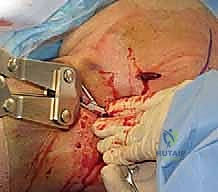 قص الأسلاك تحت مستوى الجلد