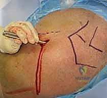 صورة شعاعية نهائية داخل العمليات