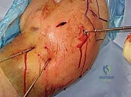 التأكد من ثبات المفصل