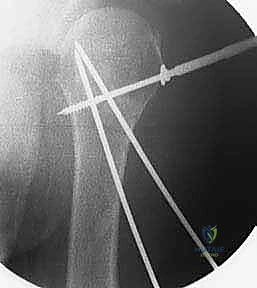 إغلاق الجروح الصغيرة