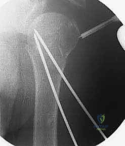 خطوة جراحية متقدمة