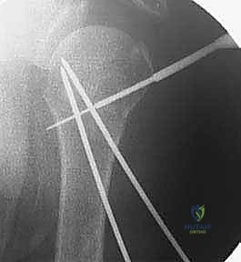 Intraoperative Surgical Step