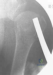 صورة توضيحية لـ تثبيت كسور عظم العضد القريب بالأسلاك عبر الجلد: دليل شامل للمرضى