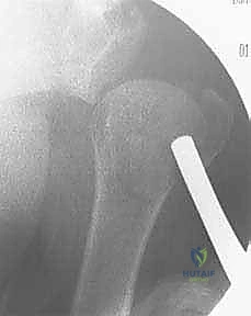 صورة توضيحية لـ تثبيت كسور عظم العضد القريب بالأسلاك عبر الجلد: دليل شامل للمرضى