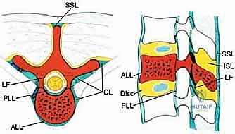 تقنية توميتا في استئصال الفقرات