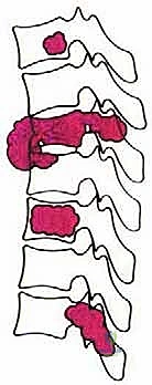 الأورام الخبيثة الأولية في العمود الفقري