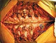 الآفات النقيلية المعزولة في العمود الفقري