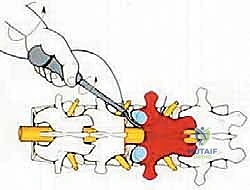 الأورام الحميدة العدوانية للعمود الفقري
