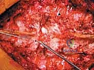 التخطيط الإشعاعي قبل جراحة أورام العمود الفقري