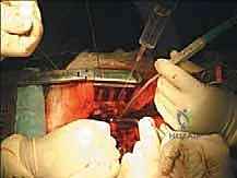 المدخل الجراحي الخلفي للعمود الفقري