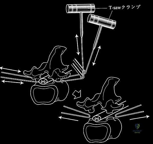 تصوير وسد الأوعية الدموية قبل الجراحة