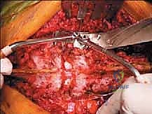 أخذ خزعة من ورم العمود الفقري