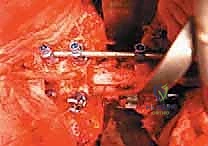 صورة طبية: استئصال الفقرة بالكامل ككتلة واحدة: ريادة الأستاذ الدكتور محمد هطيف في جراحة العمود الفقري المعقدة بصنعاء