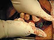 صورة طبية: استئصال الفقرة بالكامل ككتلة واحدة: ريادة الأستاذ الدكتور محمد هطيف في جراحة العمود الفقري المعقدة بصنعاء