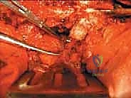 صورة توضيحية لـ استئصال الفقرة بالكامل ككتلة واحدة: ريادة الأستاذ الدكتور محمد هطيف في جراحة العمود الفقري المعقدة بصنعاء