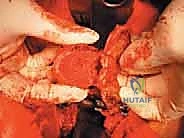 استخراج الورم ككتلة واحدة حول الحبل الشوكي