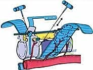 صورة طبية: استئصال الفقرة بالكامل ككتلة واحدة: ريادة الأستاذ الدكتور محمد هطيف في جراحة العمود الفقري المعقدة بصنعاء