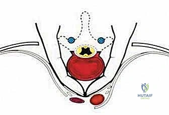 استخدام منشار T-saw في جراحة العمود الفقري