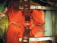 صورة توضيحية لـ استئصال الفقرة بالكامل ككتلة واحدة: ريادة الأستاذ الدكتور محمد هطيف في جراحة العمود الفقري المعقدة بصنعاء