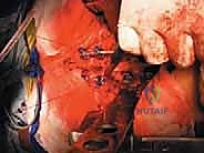 صورة توضيحية لـ استئصال الفقرة بالكامل ككتلة واحدة: ريادة الأستاذ الدكتور محمد هطيف في جراحة العمود الفقري المعقدة بصنعاء