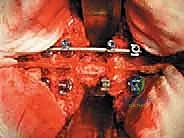 صورة توضيحية لـ استئصال الفقرة بالكامل ككتلة واحدة: ريادة الأستاذ الدكتور محمد هطيف في جراحة العمود الفقري المعقدة بصنعاء