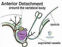 تثبيت مسامير التيتانيوم في العمود الفقري