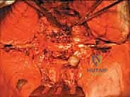 استئصال الصفيحة الفقرية وتحرير الحبل الشوكي